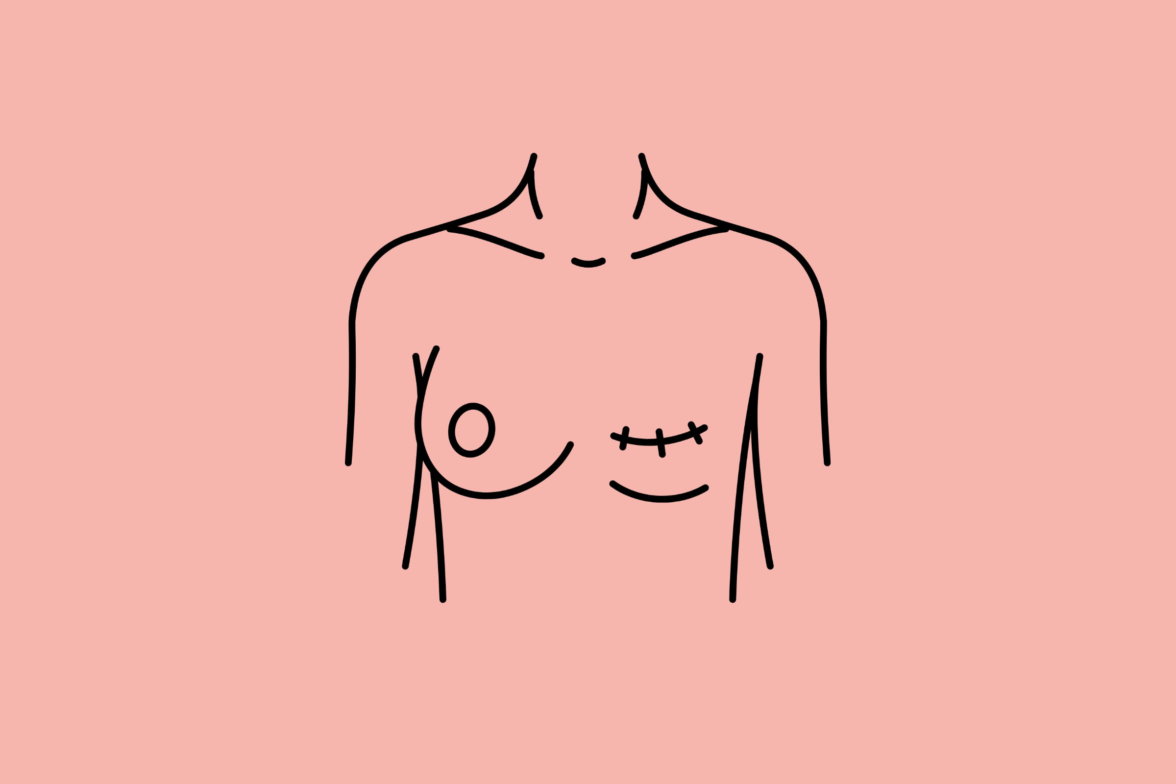 Mastectomy