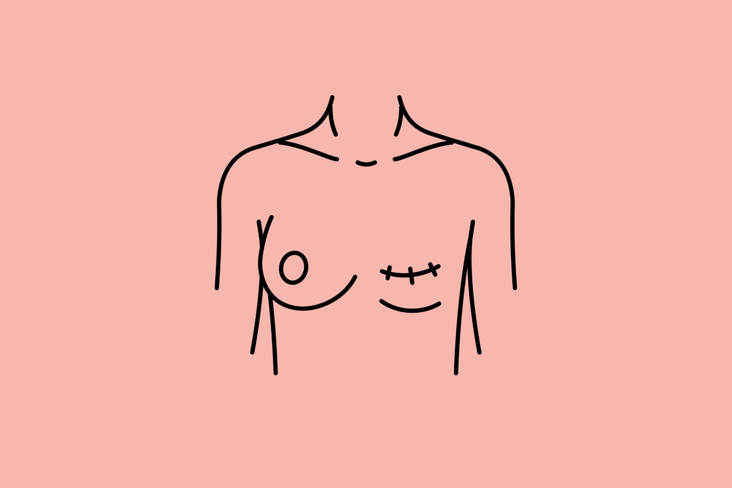 Mastectomy